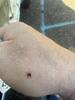 Treating for Ticks in Flagtown, NJ - Photo 1